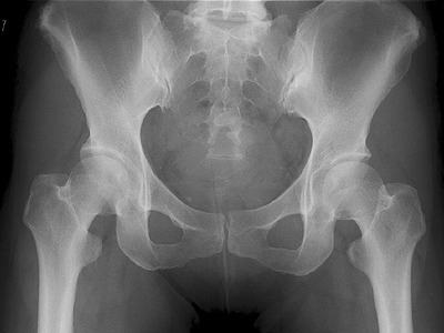 normal-hip.jpg